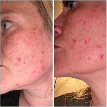 Grunsify™ tallow cream – relieves dark spots, acne scars, dryness, and has anti-aging effects.
